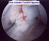 Acl_torn_arthroscopic_picture